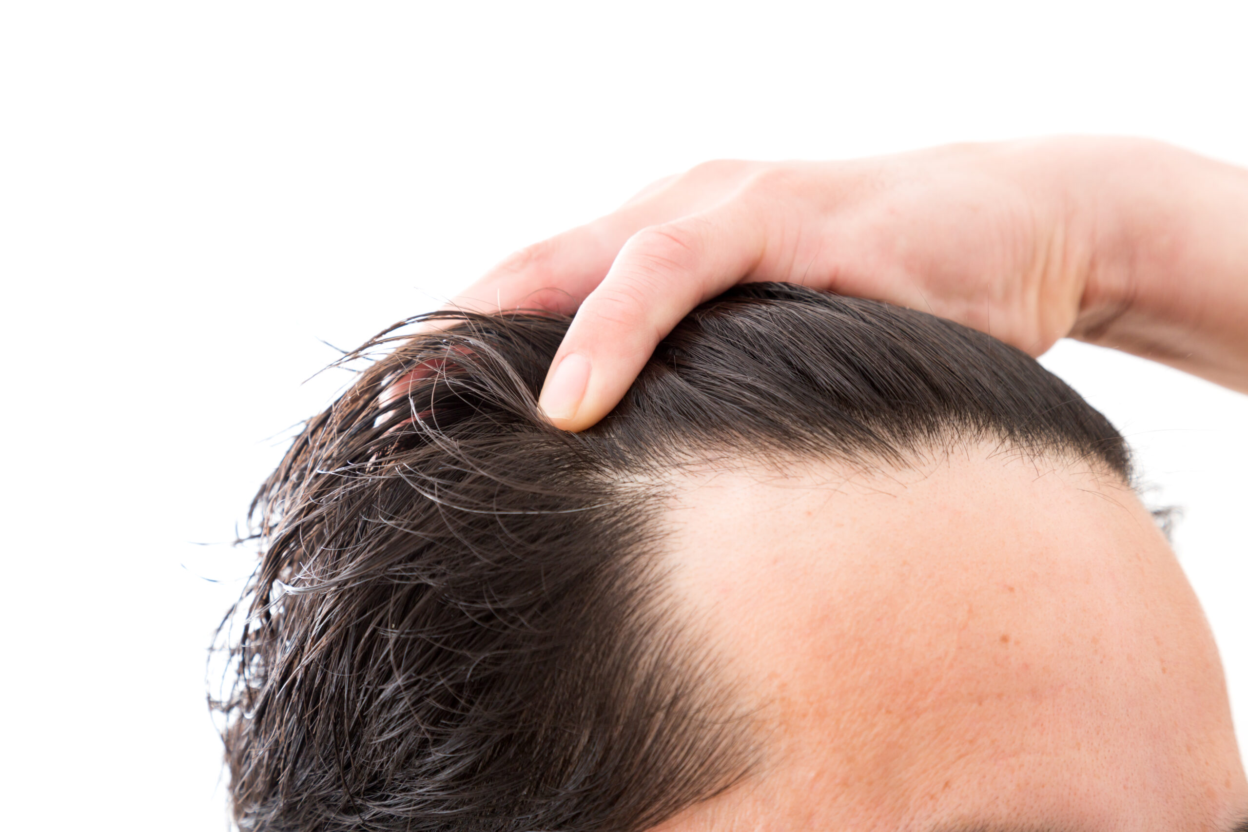スカスカな前髪・生え際は薄毛の予兆？原因と対策を徹底解説