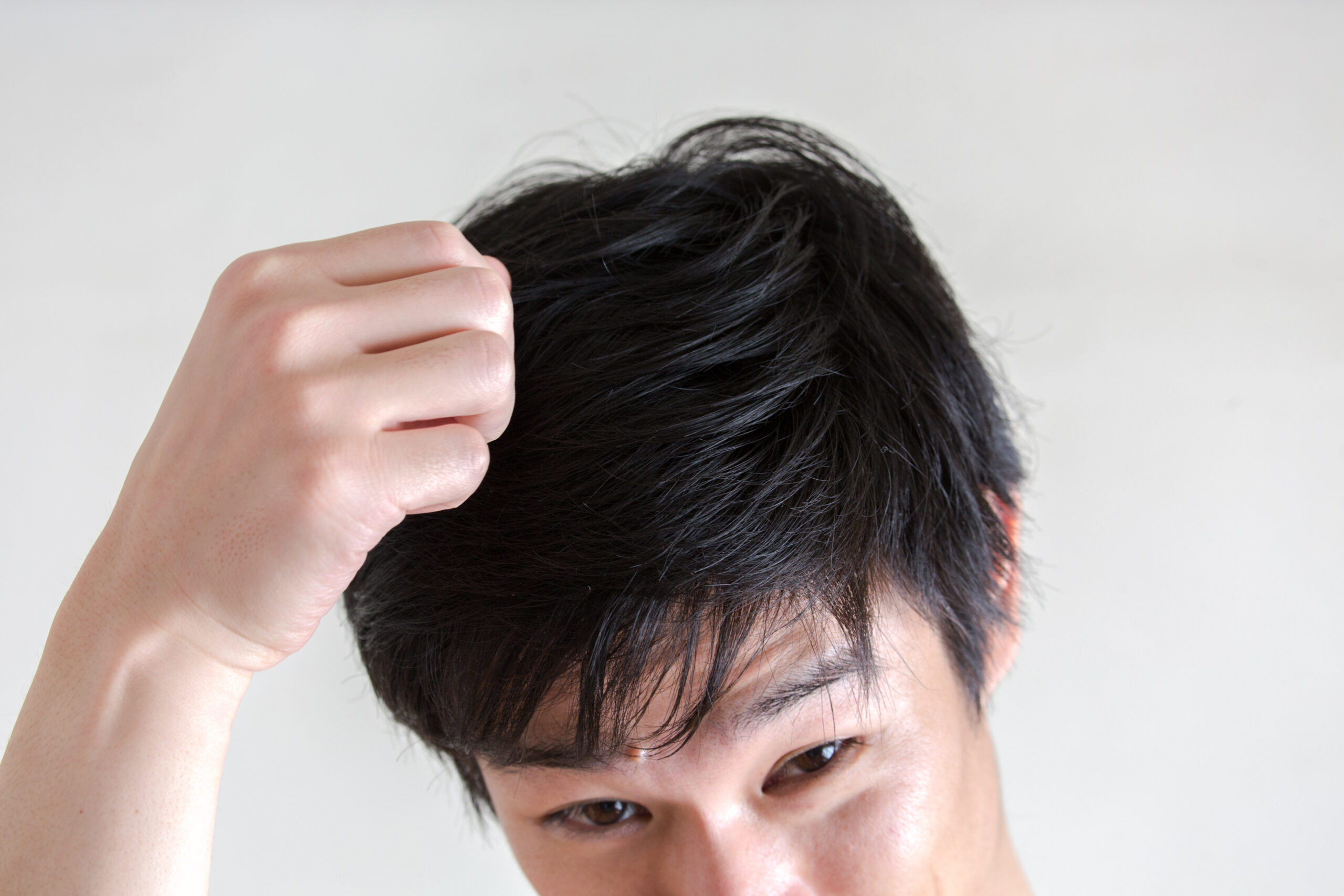 円形脱毛症のタイプとそれぞれの症状