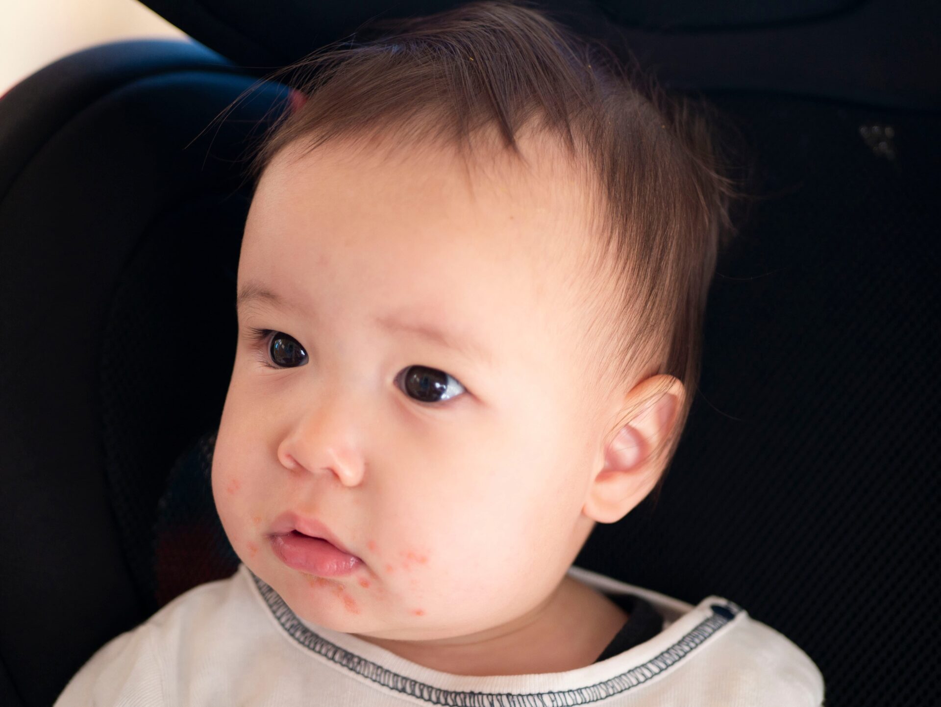 子ども・赤ちゃんの頭皮や顔にできる湿疹の種類は？